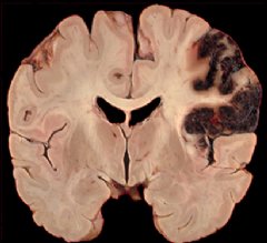 This image shows a brain with damage to the dorsolateral prefrontal cortex. (Neuropathological specimen compliments of Professor Dimitri Agamanolis, A