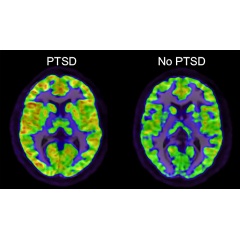 PET images indicating higher mGluR5 receptor availability in an individual with PTSD vs. a healthy comparison participant.