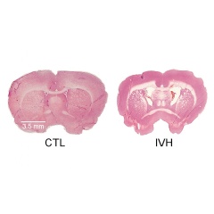 A healthy brain is pictured at left; one suffering intraventricular hemorrhage is pictured at right.