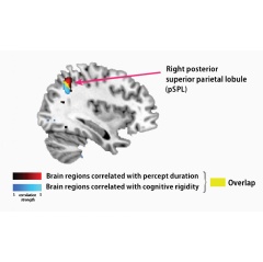 Brain regions correlated with perceptual stability & cognitive rigidity in autism. Gray matter volume in the right posterior superior parietal lobule negatively correlated with percept duration (red) & cognitive rigidity (blue). Overlapping in yellow