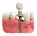 Promenade Murrieta Dental Announced Computer Guided Dental Implants