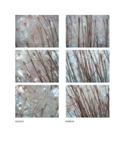 Sandys Microscopic Before and After Images Hair Loss Treatments