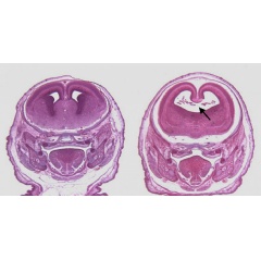 Stained sections of fetal mouse brains (Left) Control (Right) Mouse exposed to alcohol and a cannabinoid on the 8th day of pregnancy. Black arrow highlights enlarged cerebral ventricle caused by the loss of the midline septal region.Dr. Scott Parnell