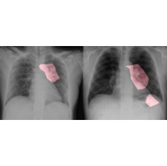 Key areas are highlighted in pink in these chest radiology images of two patients with COVID-19