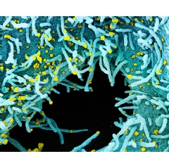 Colorized scanning electron micrograph of a cell heavily infected with SARS-CoV-2 virus particles (yellow), isolated from a patient sample. The black area in the image is extracellular space between the cells. (See complete caption below) NIAID