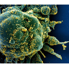 Colorized scanning electron micrograph of an apoptotic cell (green) heavily infected with SARS-COV-2 virus particles (yellow), isolated from a patient sample. NIAID