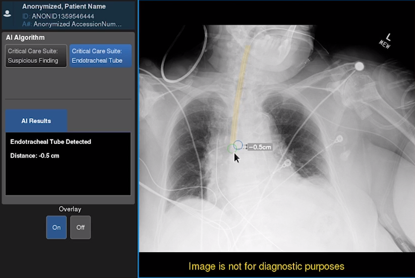 GE Healthcare Announces First Xray AI to Help Assess Endotracheal Tube