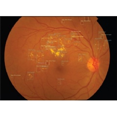Sankara Eye Foundation and Leben Care are deploying Netra.AI, a comprehensive retina risk assessment software-as-a-service platform, in India. (see complete caption below)(Credit: Sankara Eye Foundation)