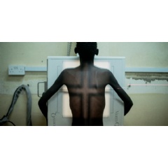 Luca Sola/
Simbazako, 19, undergoes radiography for tuberculosis in Nsanje district hospital in Malawi. TB is the leading cause of death for people living with HIV.