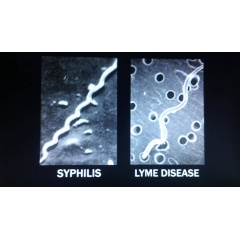 Corkscrew-shaped spirochetes that cause syphilis (left) and Lyme disease (right). ©Open Eye Pictures. Used with permission.