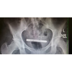 X-Ray of the Pelvis Shows an Extremely Narrow Vibrator Lodged in the Bladder, Prior to Surgical Removal by the Marchand Institute