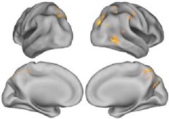 Shown are scans that represent all subjects with beta-amyloid deposits in their brain. The yellow and orange colors show areas where greater brain act