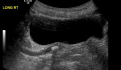 An ultrasound image of the bladder showing a ureter blocked by a kidney stone.