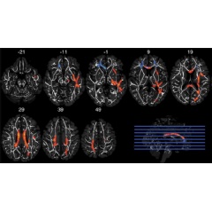 Figure 1. Axial MRIs show results of tract-based spatial statistics analysis of white matter fractional anisotropy clusters of voxels with a significant crossover interaction