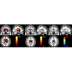 Figure 3. Stroke lesions.
Color bar denotes the t values.
